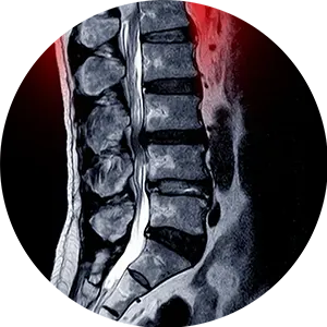 Spinal Stenosis Treatment Near Me in Arlington, TX. Chiropractor For Spinal Stenosis Pain Relief.